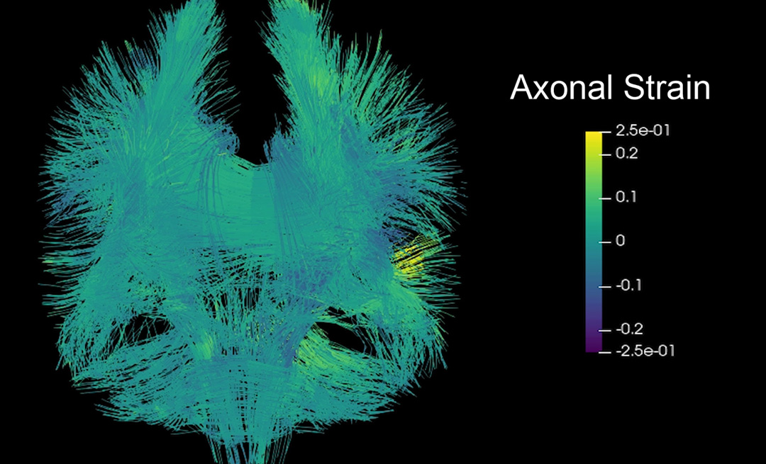 3D image of brain injury damage